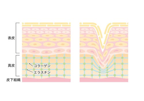 肌のシワの断面図